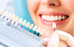 Shade guide held next to a bright smile