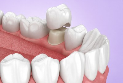 Illustration of a dental crown being placed