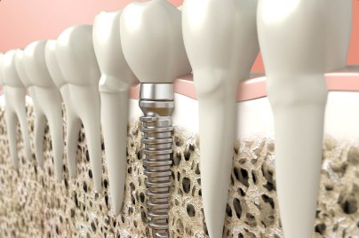 Illustration of a dental implant among natural teeth